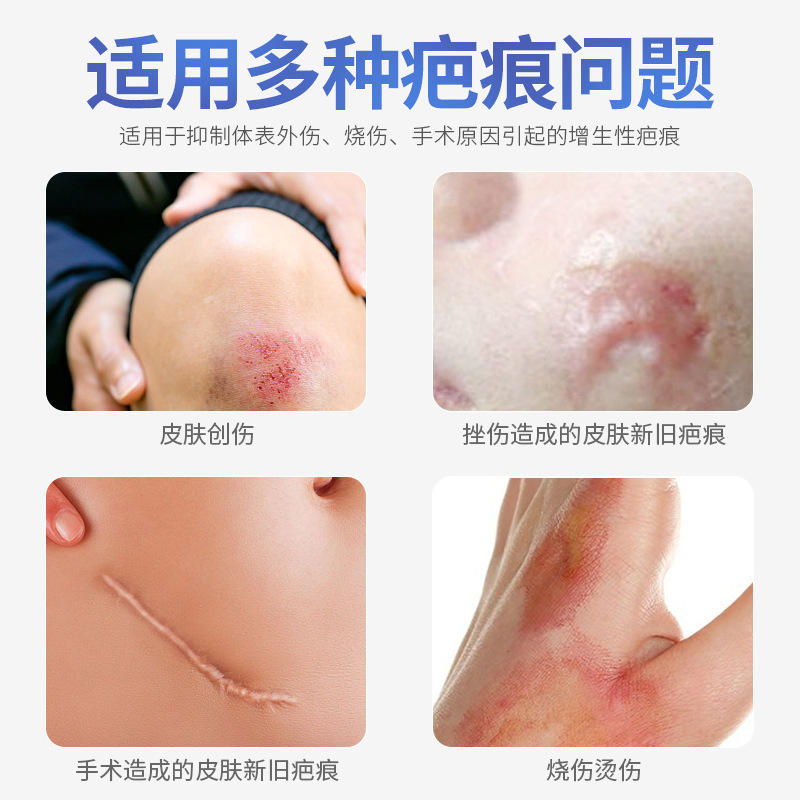 Noyle 찬 젤 유화를 가진 caesarean 단면도의 의학 재활