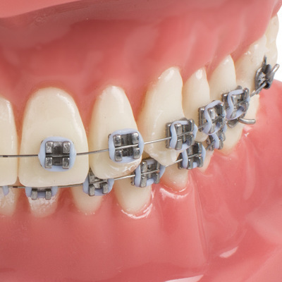 Dental belt metal troughs, orthodox red model teeth, pedagogue model.